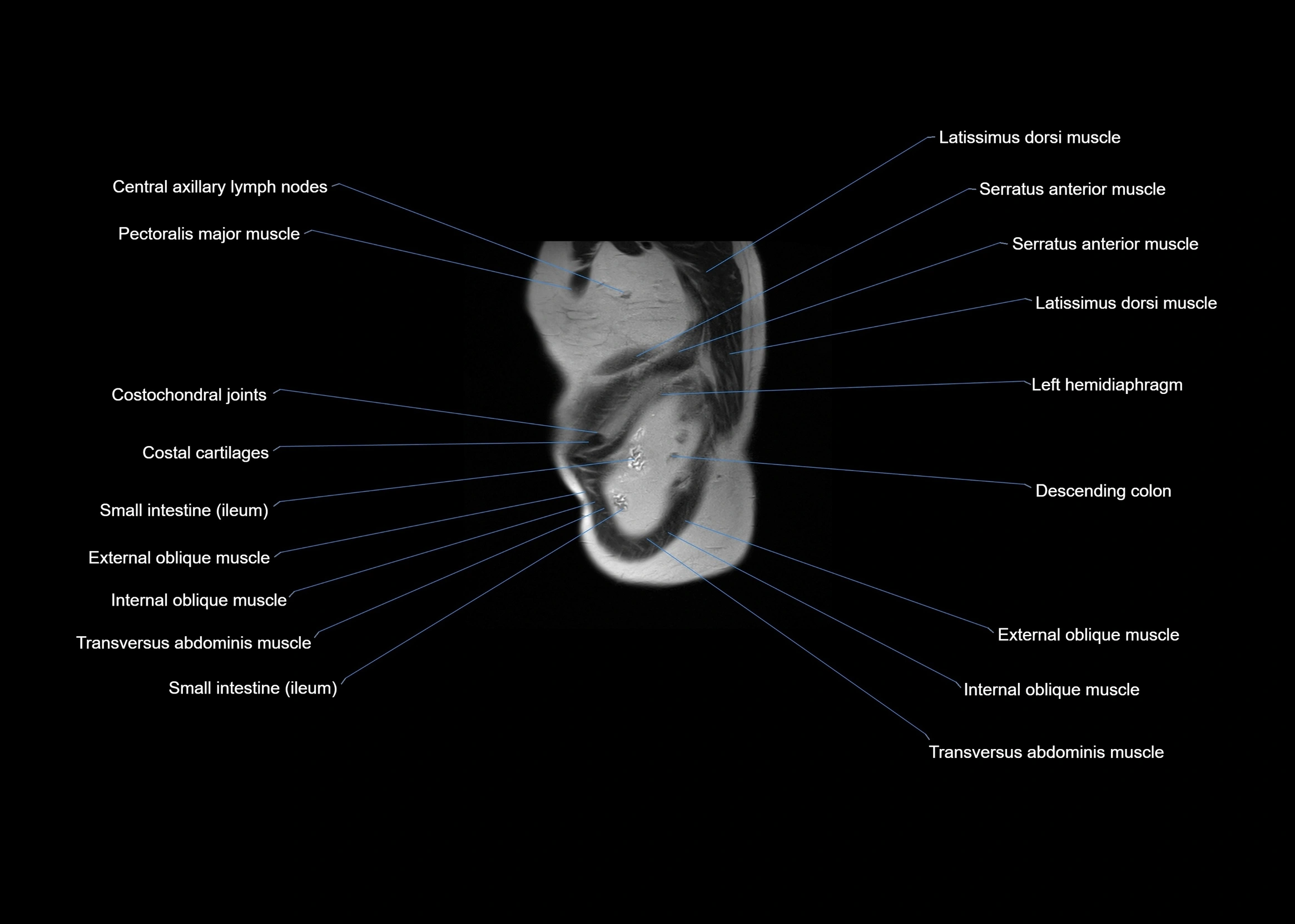 MRI abdomen sagittal cross sectional anatomy  radiology  image-img-00001-00065.webp
